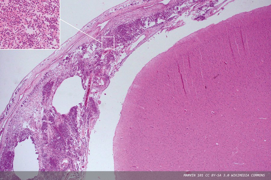 Bacterial meningitis: an important healthcare issue in focus