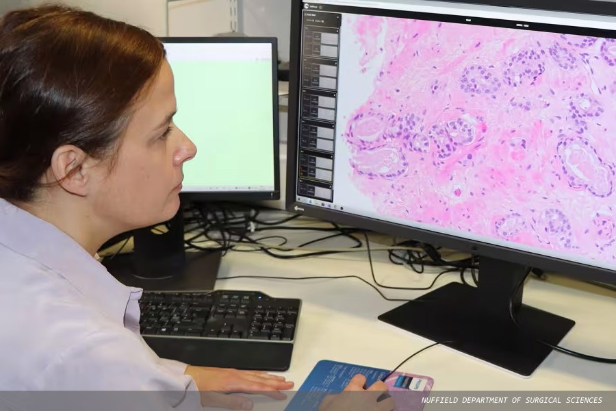Study shows AI can be safely deployed in NHS prostate cancer diagnosis