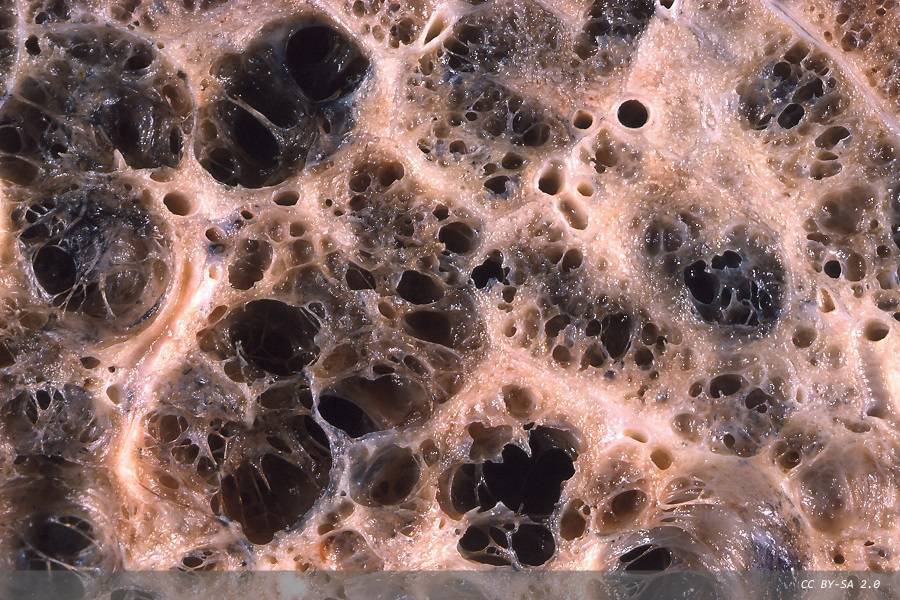 Diagnostics for asthma and COPD: development and commercialisation