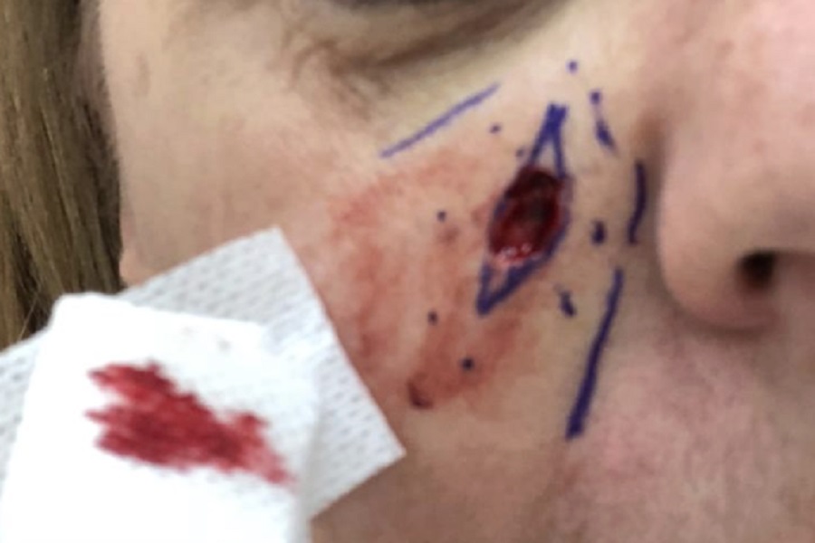 Trial to bring label-free laser histopathology to Mohs skin cancer surgery