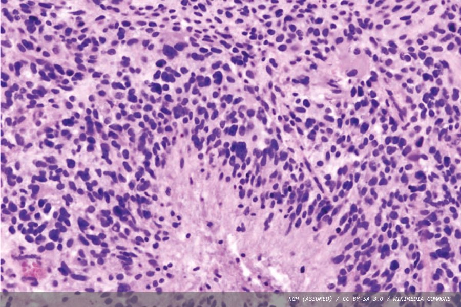 Glioma tumour biology: from histopathology to molecular diagnostics