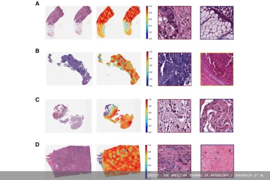 Novel AI model detects gene mutations and predicts biomarkers